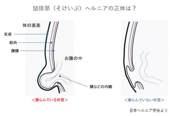 鼠経ヘルニア