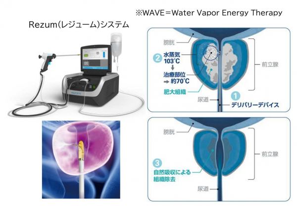 経尿道的水蒸気治療(WAVE)